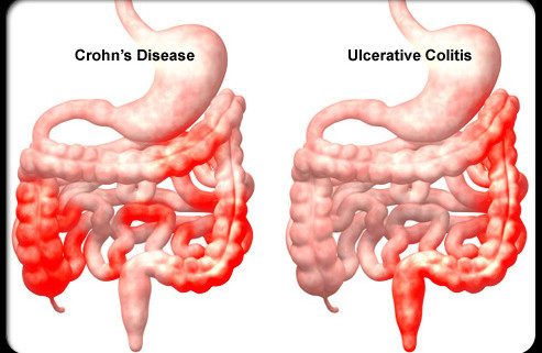 Read more about the article Crohn’s Disease- Treating Disease With Diet